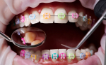 Aparat Invisalign – innowacyjność i wygoda w ortodoncji